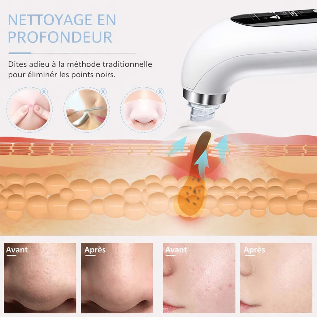 Aspirateur à points noirs à microbulles électrique 5 en 1 - Nettoyage profond de la peau, exfoliant, hydratation, anti-acné, extracteur - Visage